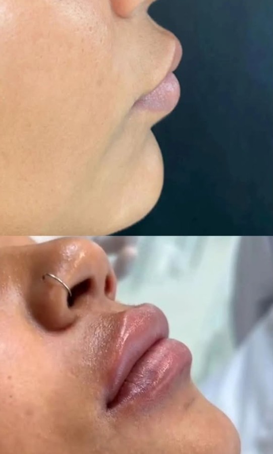 Resultado Preenchimento Labial