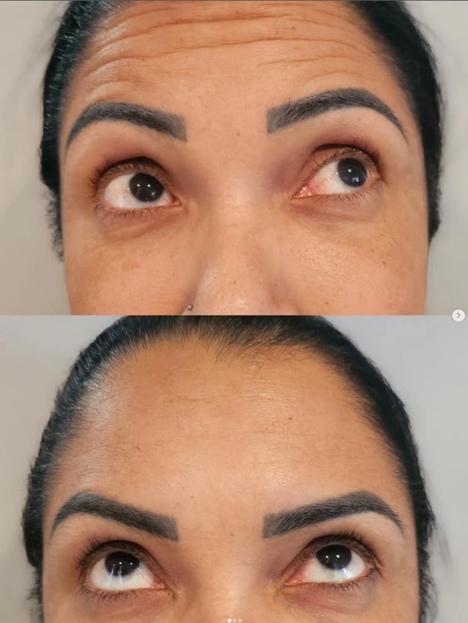 Resultado Toxina Botulínica
